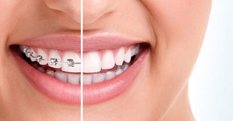 ortodonzia-trattamenti-768x400_800x417